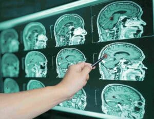 head injury lawyer in Richmond, VA